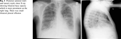 Posterioranterior Left And Lateral Right Chest X Ray Showing