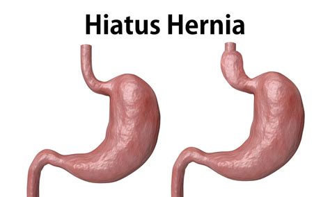 Hiatal Hernia Size Chart Hernia Hiatal Symptoms Mthfr Hiatus