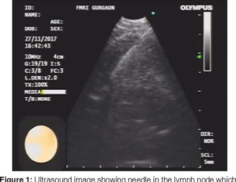 Figure From A Rare Complication During Endobronchial Ultrasound