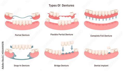 Dental prosthesis types set. Dental implant, partial, snap-in, bridge ...