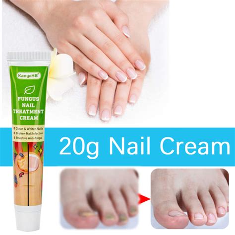 20g Nail Cream Fungus Treatment Cream Removal Nail Paronychia