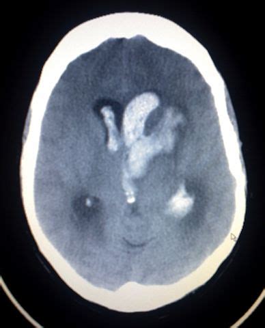 Edema Cerebral S Ntomas Causas Y Tratamiento