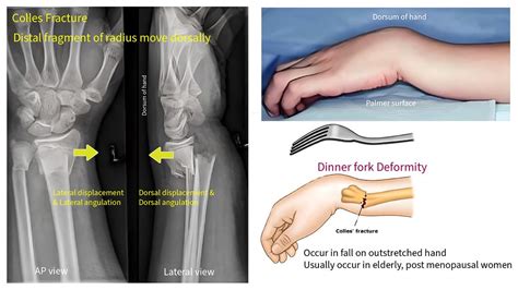 Colles Fracture - Emedicodiary