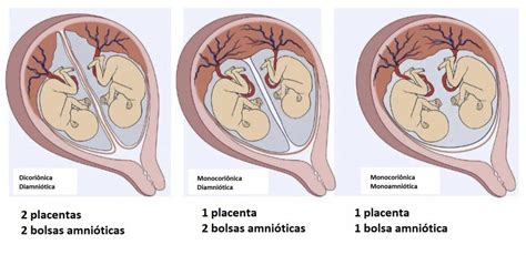 Tipos De Gravidez Gemelar Sacada De Mãe