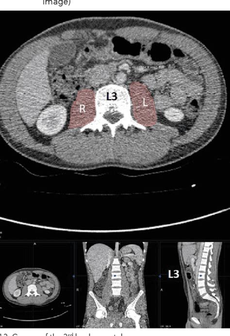 Figure From The Psoas Muscle Index And Retrospective Clinical Frailty