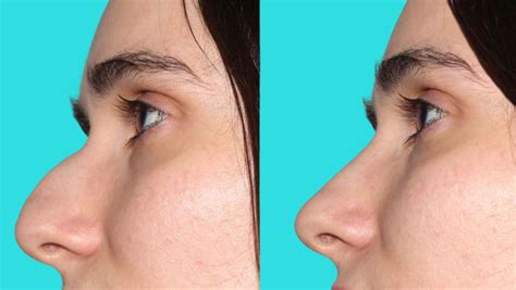 Expert Rhinoplasty Miami Nose Youve Always Wanted