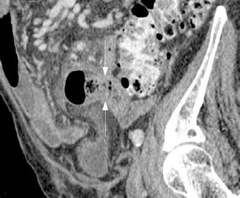 Acute Ulcerative Jejunal Diverticulitis Case Report Of An Uncommon Entity