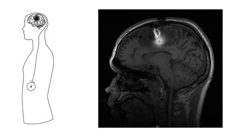 Brain Cancer How Columbia Researchers Are Fighting Back Columbia