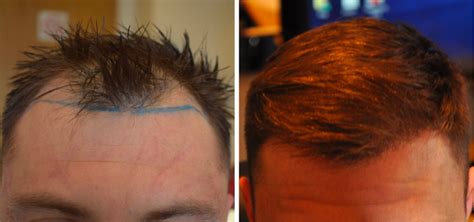 The Best Hair Loss Treatment For Men Wimpole Clinic