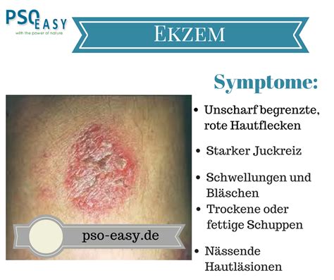 Ekzem Und Seine Symptome Medizin Haut Hauterkrankungen