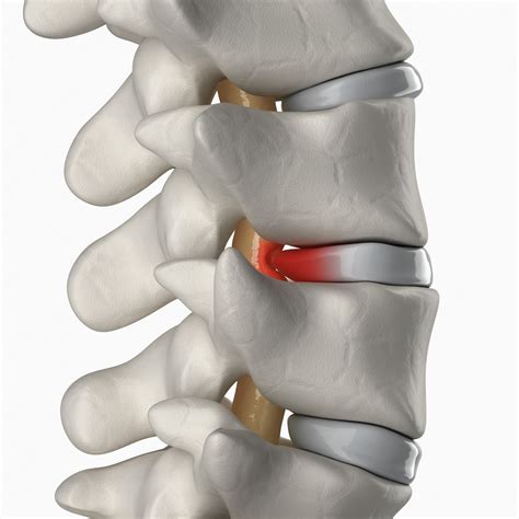 Discseel Procedure for Bulging Discs in Wisconsin | Innovative Relief