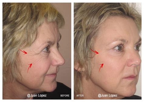 Botox Treatment For Lines And Wrinkles Skinmedico Clinic London