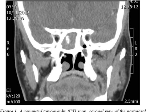 Table 1 From Sphenoid Sinus Fungal Ball A Tertiary Hospital Experience Semantic Scholar