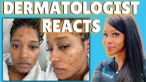 Treating Hormonal Adult Acne Youtube