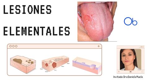 Lesiones Elementales En Cavidad Bucal Youtube