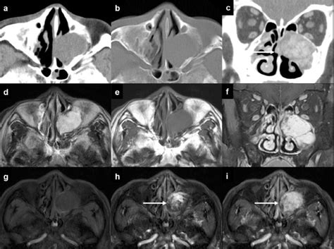 Imaging Features Of Benign Mass Lesions In The Nasal Cavity And