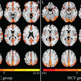 Brain Regions Showing Decreased Alff In Patients With Hcv Infection