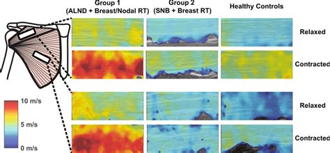 Representative Ultrasound Shear Wave Elastography Maps Collected From Download Scientific