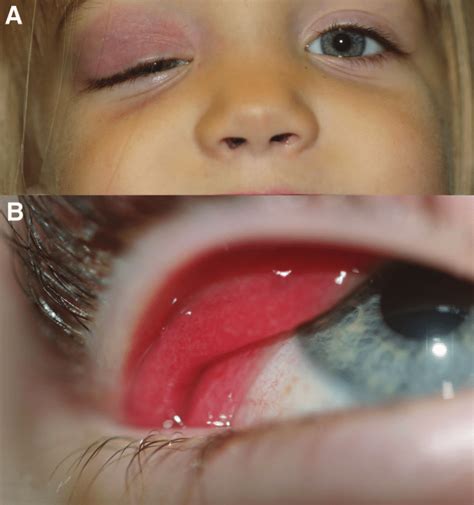 A Purplish Hue And Near Complete Ptosis Of The Right Upper Eyelid 7