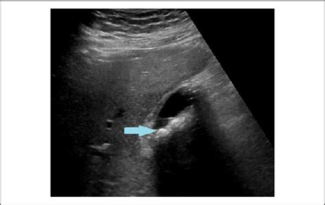 Gallstones Ultrasound