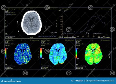 Perfusión Tomografía Computarizada Del Cerebro Imagen de archivo