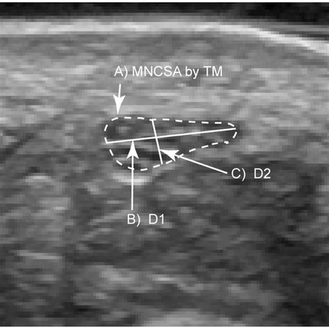 Median Nerve Ultrasound