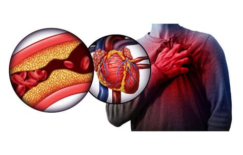 Infarto Sintomas Em Mulheres Preven O Fator De Risco