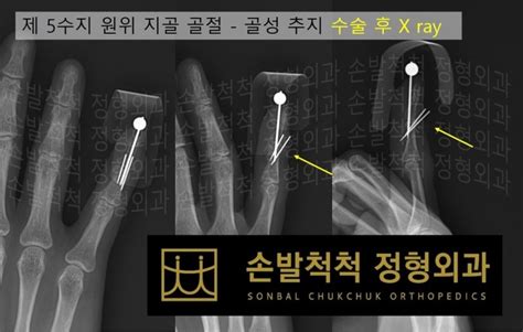 손발척척 정형외과 수술센터 수술센터 수술센터 골성추지수술원위지골골절손가락뼈골절수술