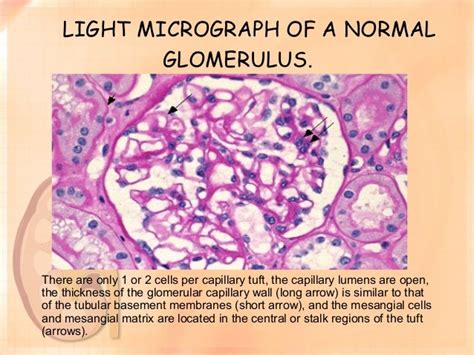 Pathogenesis Of Glomerulonephritis