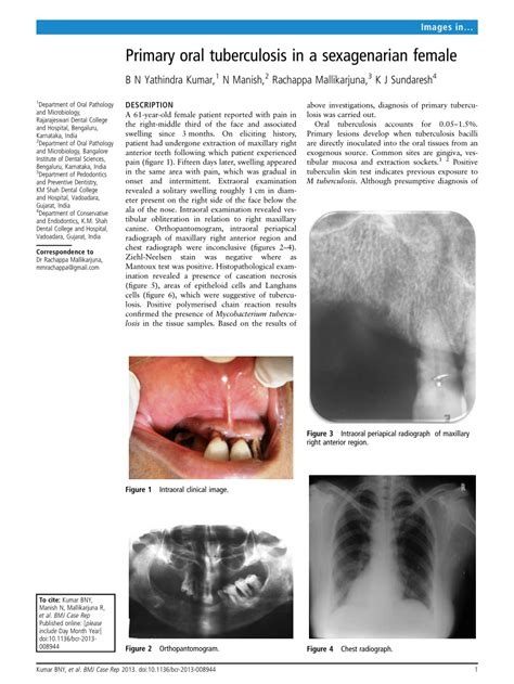 Pdf Primary Oral Tuberculosis In A Sexagenarian Female