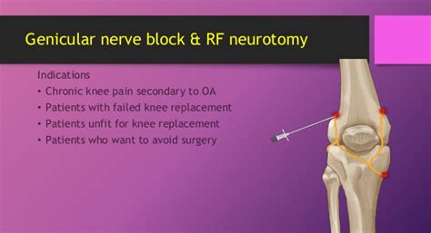 Genicular Nerve Anatomy