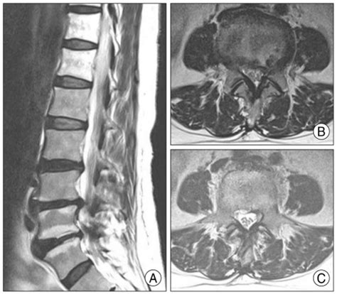 Spontaneous Regression Of A Large Lumbar Disc Extrusion PMC