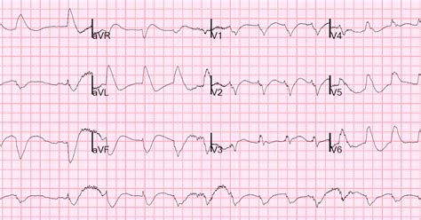 Dr. Smith's ECG Blog: Cardiac Arrest -- Is it STEMI?