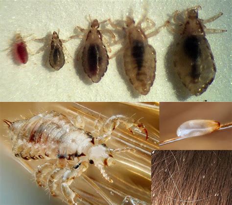 Ciclo De Vida De La Pediculosis Capitis