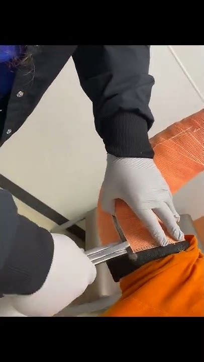 Long Arm Cast Removal Youtube