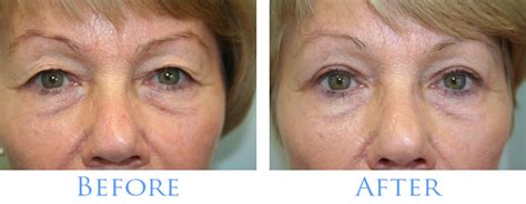 Cosmetic Therapy Blogs How Long Does It Take To Recover From Eyelid Surgery