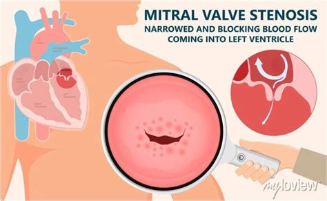 Cath Lab Atrial Septal Defect Tetralogy Of Fallot Patent Foramen Canvas