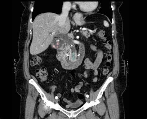 Mercedes Benz Sign In Gall Bladder Stone A Radiograph Of The Abdomen