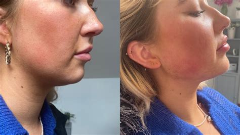 Jaw And Chin Fillers Perfect Aesthetics Plymouth