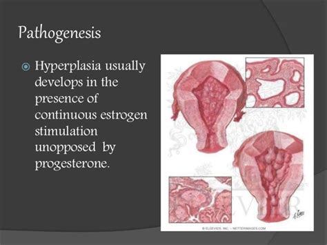 Endometrial Hyperplasia