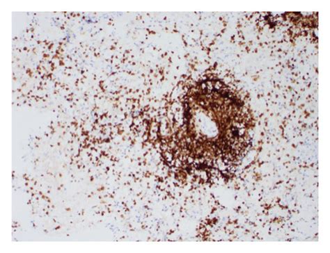 Cns Biopsy A Lymphomatous Infiltrate Is Predominantly Perivascular