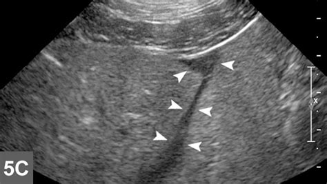 Ultrasound-Guided Biopsy of the Liver | Clinician's Brief