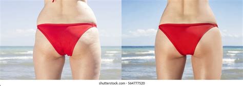 Female Buttocks Before After Cellulite Stock Photo Shutterstock