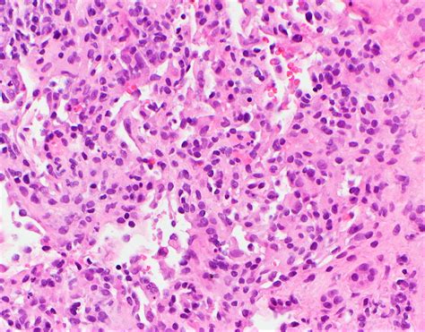 Pathology Outlines Hemangioma