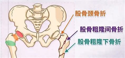 髋部骨折为什么是人生的最后一次骨折 中国医疗