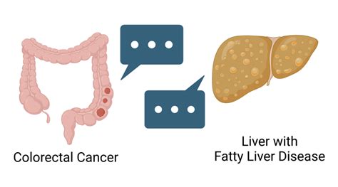 How Fatty Liver Disease Helps Cancer Thrive In The Liver Cedars Sinai Pulse