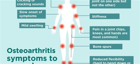 Symptoms of osteoarthritis (osteoarthritis) – Healthy Food Near Me