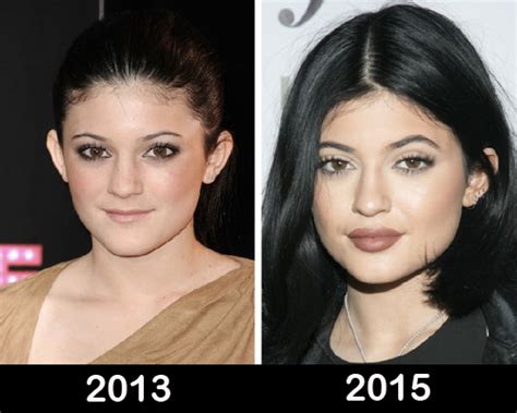 Kylie Jenner Plastic Surgery Before After Photos Celebrity Surgery Before And After