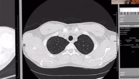 I was diagnosed with idiopathic interstitial lung disease. : r/Radiology