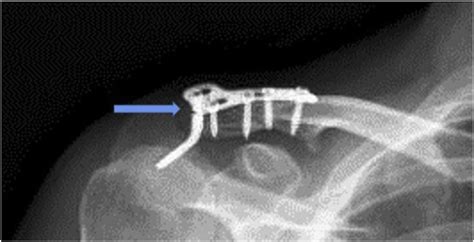 Anteroposterior Radiograph Of A Fully United Neer Type 2 Distal Download Scientific Diagram